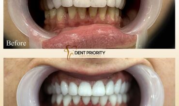 dent-priority-11
