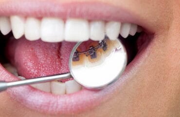 aparat dentar dentpriority img1