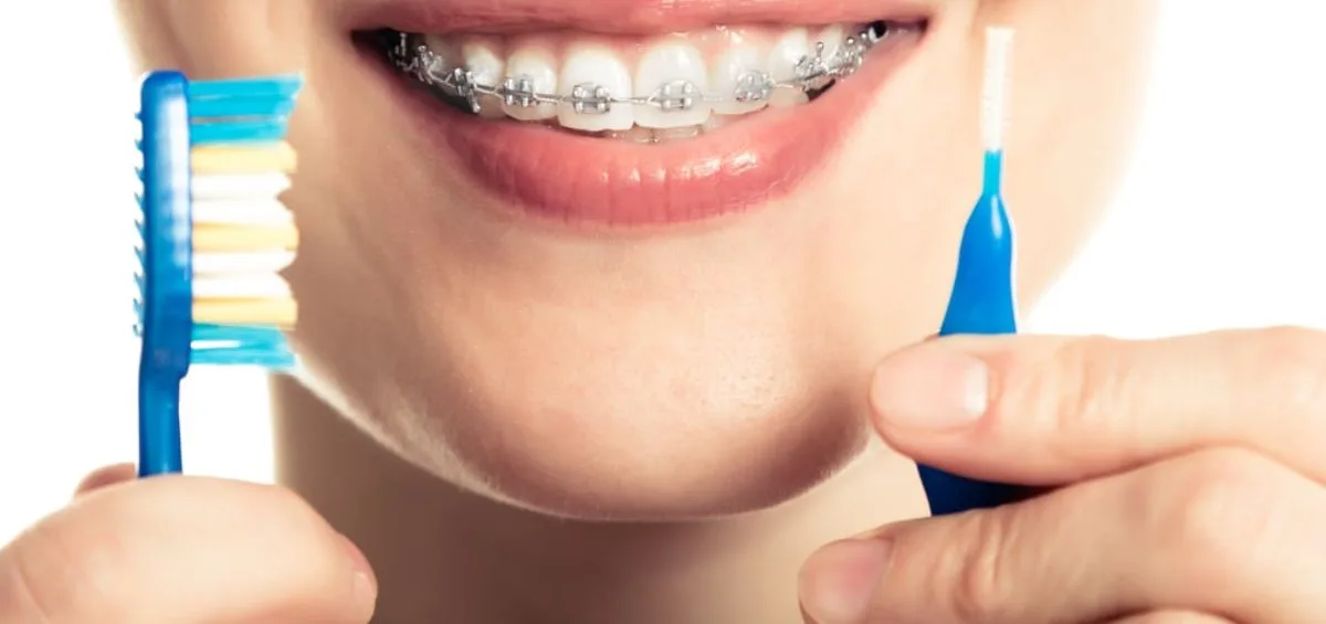 Cum să îți menții sănătatea orală atunci când porți aparat dentar