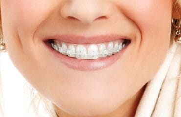 aparatul-dentar-din-safir