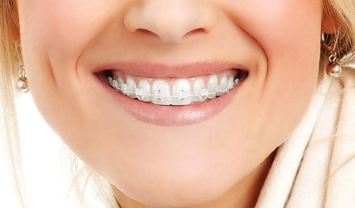 aparatul-dentar-din-safir