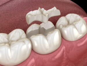 Ce sunt fisurile dentare și cum pot să evolueze?