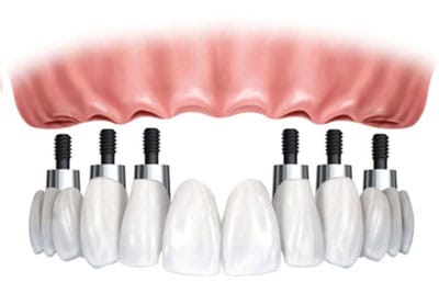 Campanie implantologie