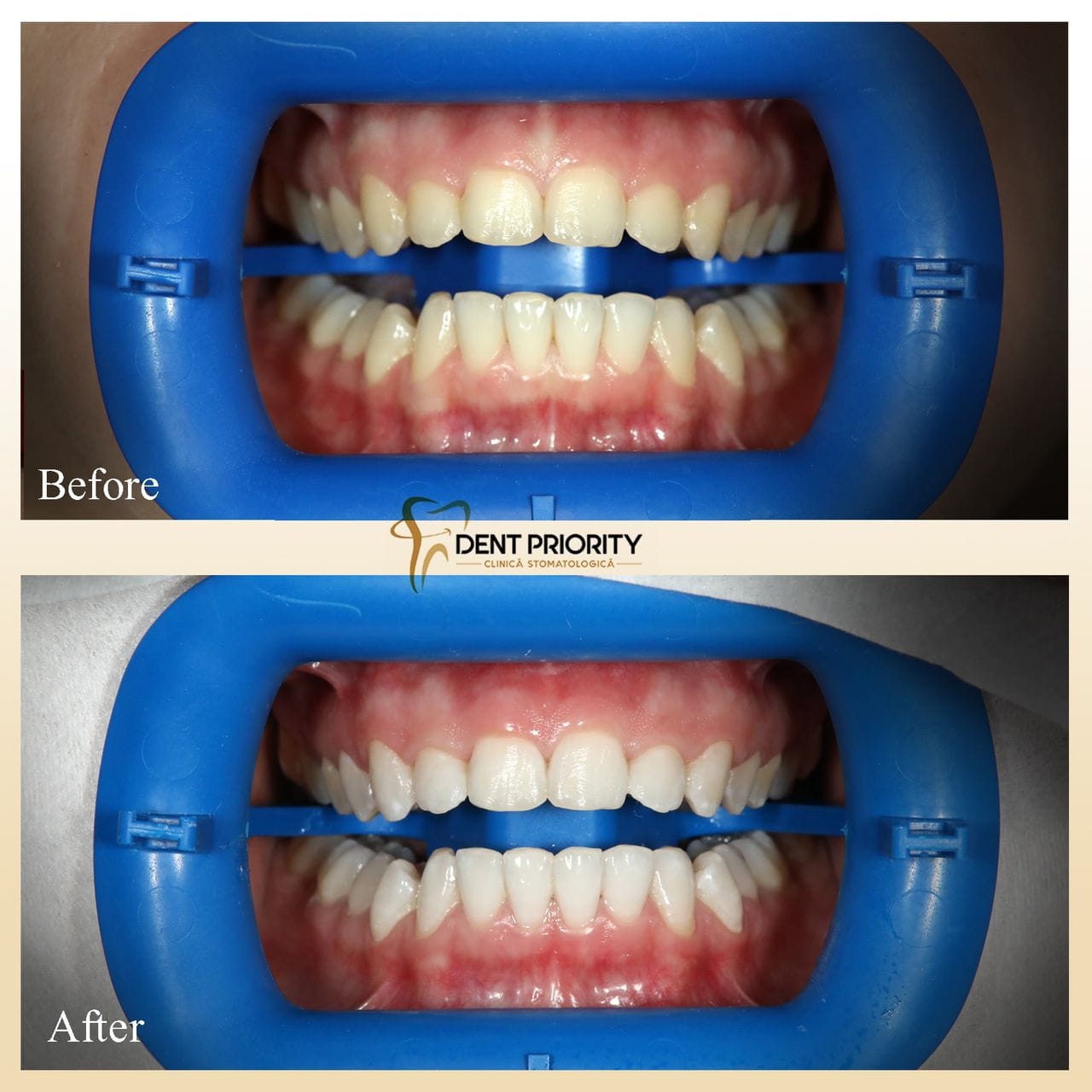 Când este momentul potrivit să optezi pentru albirea dentară cu laser